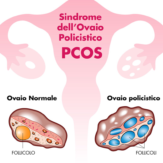 Sindrome Ovaio Policistico